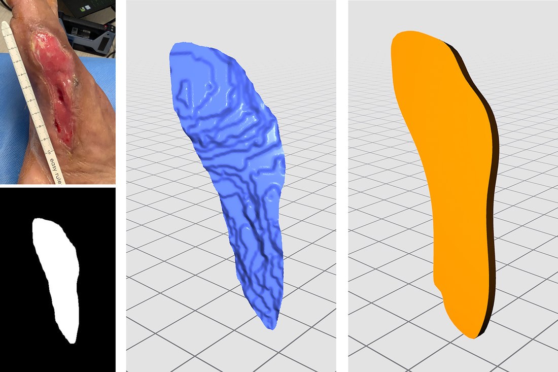 Wound capture → AI segmentation & 3D reconstruction
