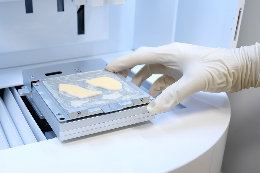 Personalized 3D-bioprinted regeneration patch
